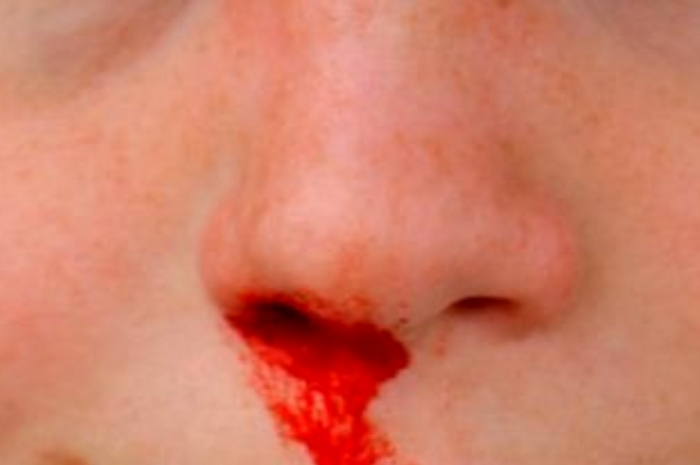 Sering Mimisan? Berikut Penyebab, Cara Mencegah dan Cara Mengatasi Hidung Mimisan